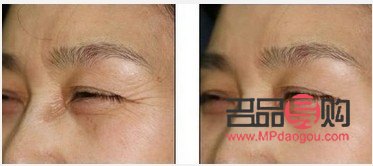 眼睛下面皱纹怎么去除最有效果呢(眼睛下面皱纹怎么去除最有效果呢视频)