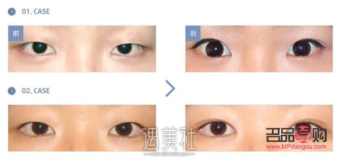 <h1>内眼角开太大了怎么办？专业解答与应对策略</h1>