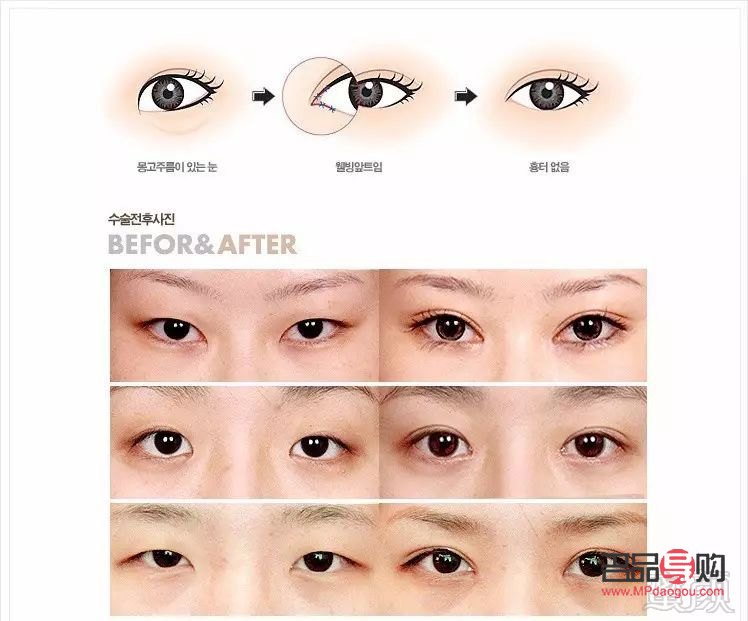 哪种眼睛适合开外眼角