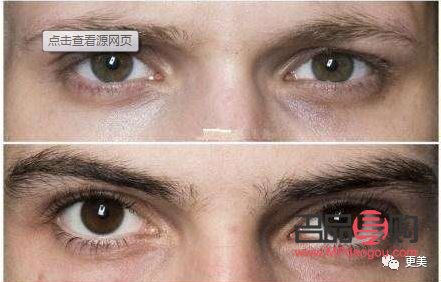 解决眼窝凹陷的最佳方法