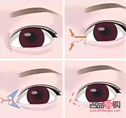 <h3>开眼角与不开眼角的区别图解</h3>