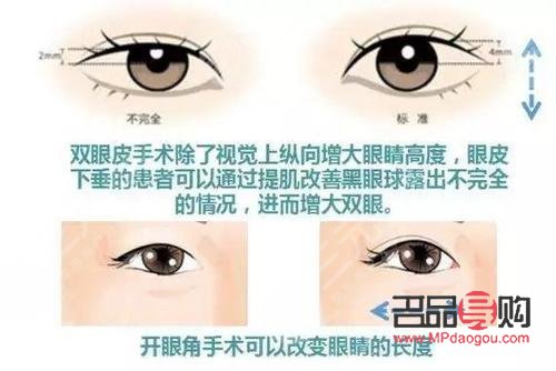 <h3>开眼角与不开眼角的区别图解</h3>