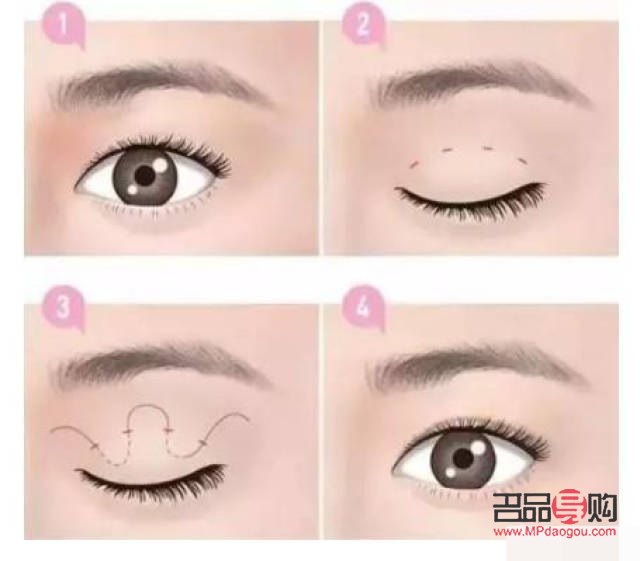 什么叫假性双眼皮(什么叫假性双眼皮手术)