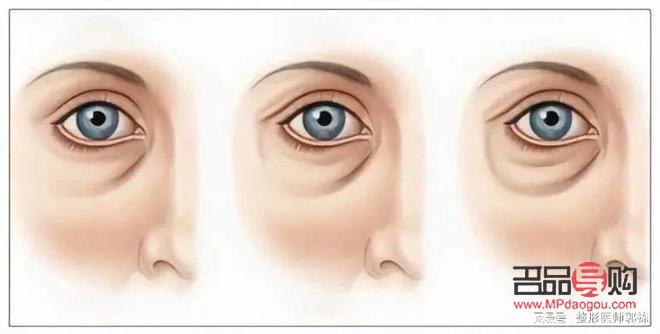 不开刀去眼袋有几种方法(不开刀去眼袋有几种方法视频)