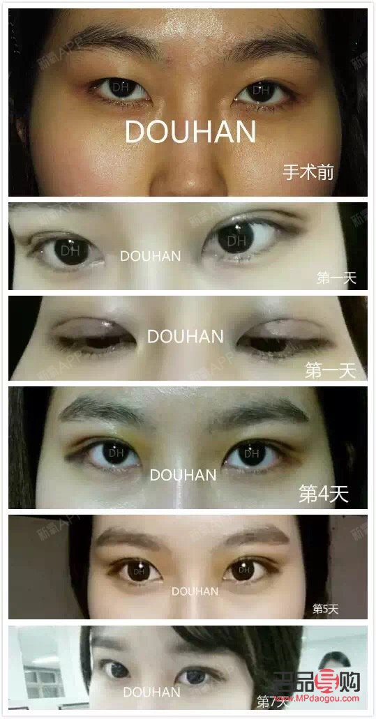 <h3>双眼皮是什么眼睛</h3>