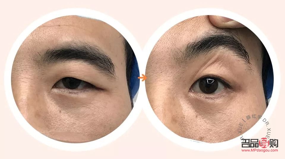 做双眼皮提肌与不提肌的区别案例(双眼皮提肌和不提肌的图片对比)