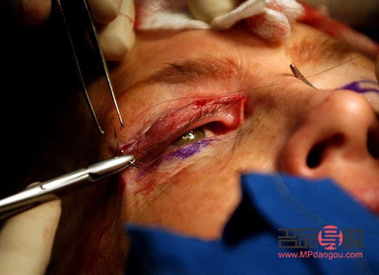 眼睛动手术全过程解析