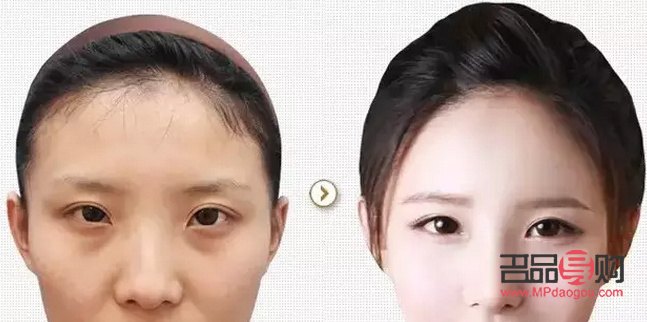 内双适不适合割双眼皮(内双适不适合割双眼皮手术)