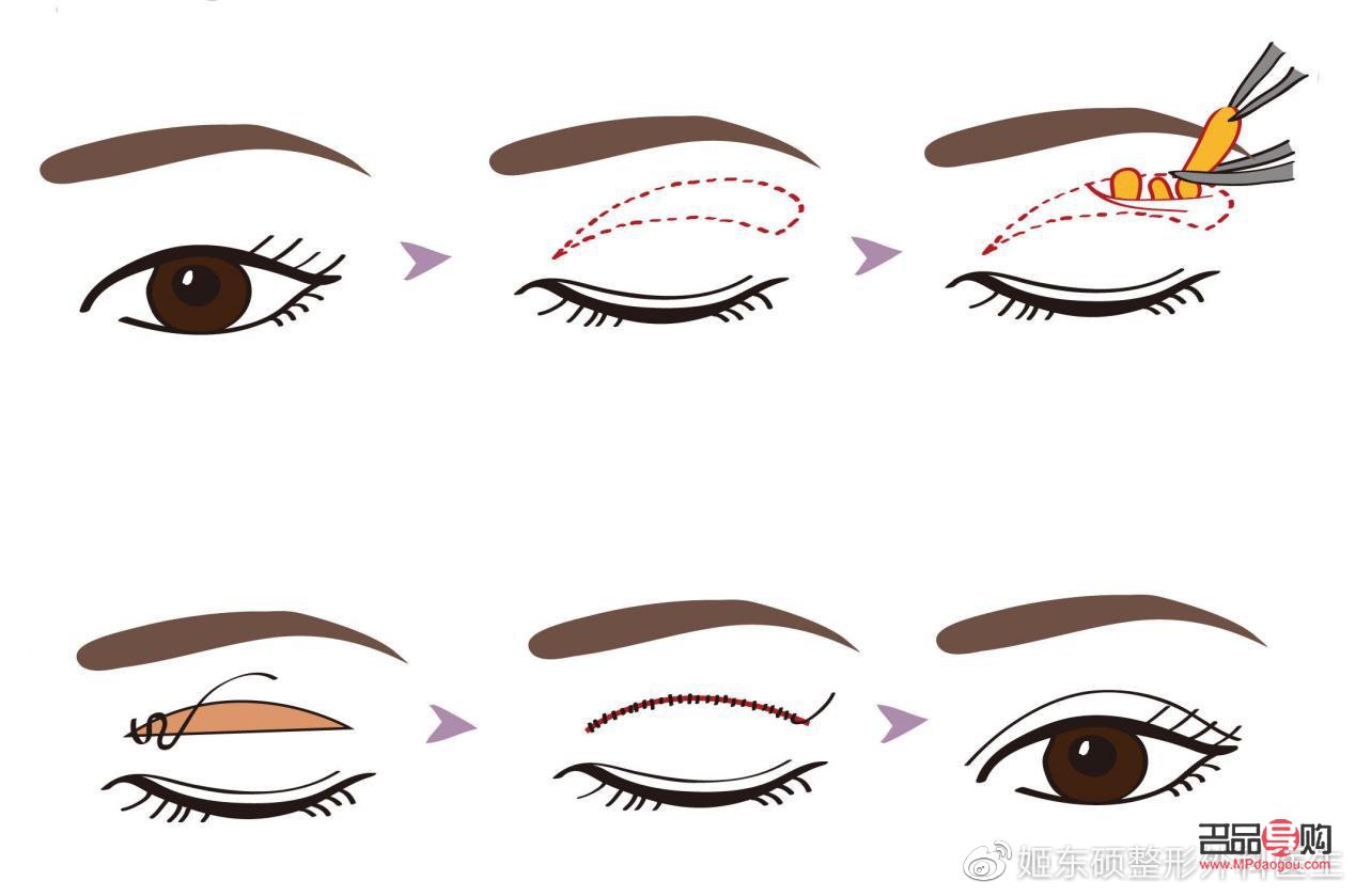 双眼皮眼皮松弛下垂最好解决方法(双眼皮眼皮松弛下垂最好解决方法是什么)