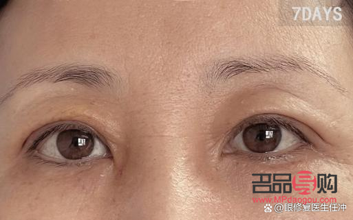 双眼皮眼皮松弛下垂最好解决方法(双眼皮眼皮松弛下垂最好解决方法是什么)