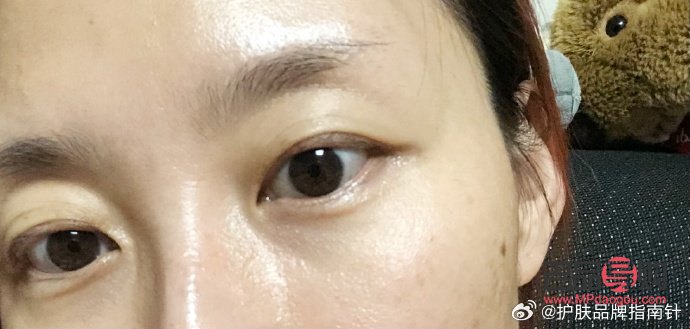 <h3>天生肿眼泡热敷是否有用？</h3>