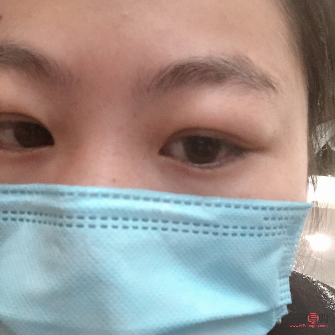 天生肿眼泡热敷是否有用？