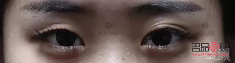 <h3>大小眼手术失败:原因、影响与应对策略</h3> <h3>大小眼手术失败:原因、影响与应对策略</h3>