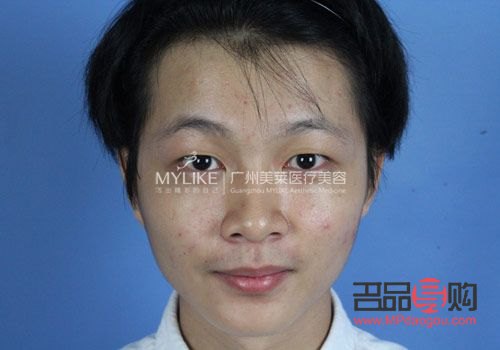 <h3>大小眼手术失败:原因、影响与应对策略</h3> <h3>大小眼手术失败:原因、影响与应对策略</h3>