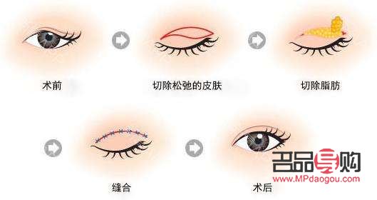 眼皮下垂最好解决方法百度知道(眼皮下垂的治疗方法)