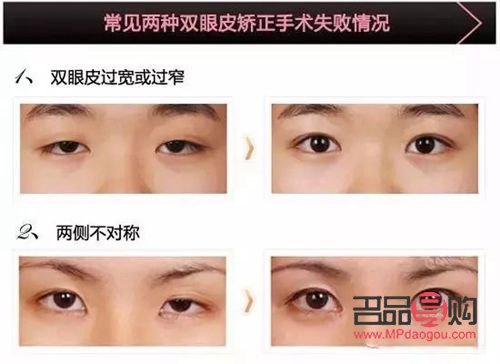 大小眼手术(大小眼手术多久恢复)