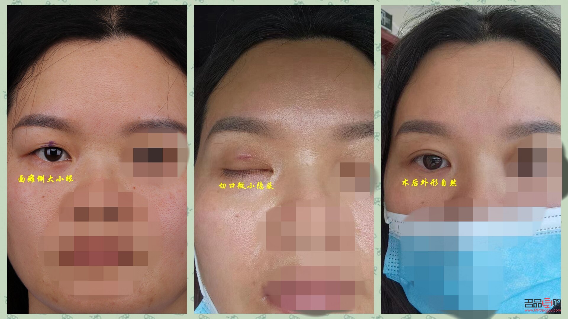 大小眼手术(大小眼手术多久恢复)