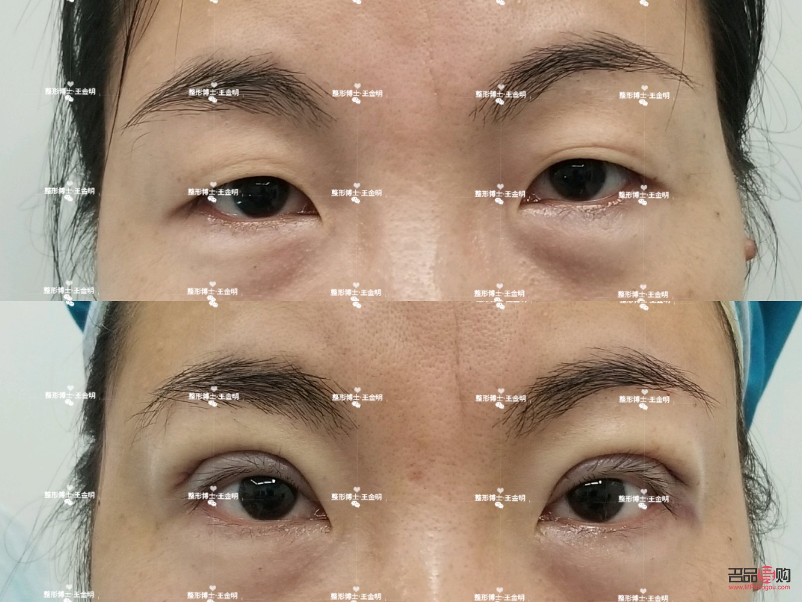 大小眼手术(大小眼手术多久恢复)