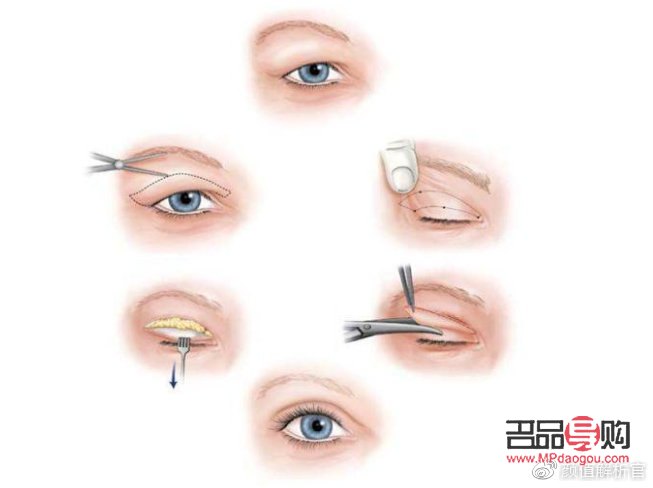 <h3>双眼皮太宽能否改窄？专业解答与操作建议</h3>