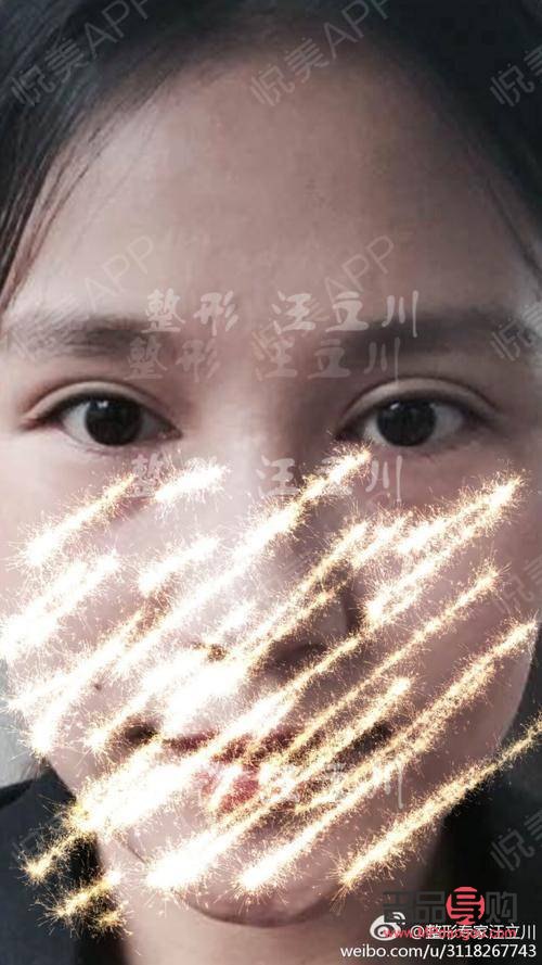 双眼皮太宽能否改窄？专业解答与操作建议