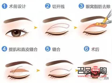 双眼皮简约天花效果图多少钱一个(双眼皮天花价格)