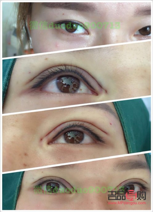 芭比眼综合多久能恢复好一点(芭比眼综合恢复过程)