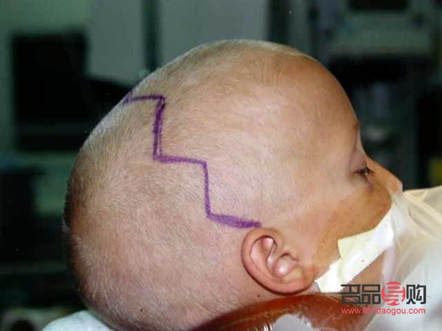 <h3>颅缝早闭与大小眼的关系探究</h3>