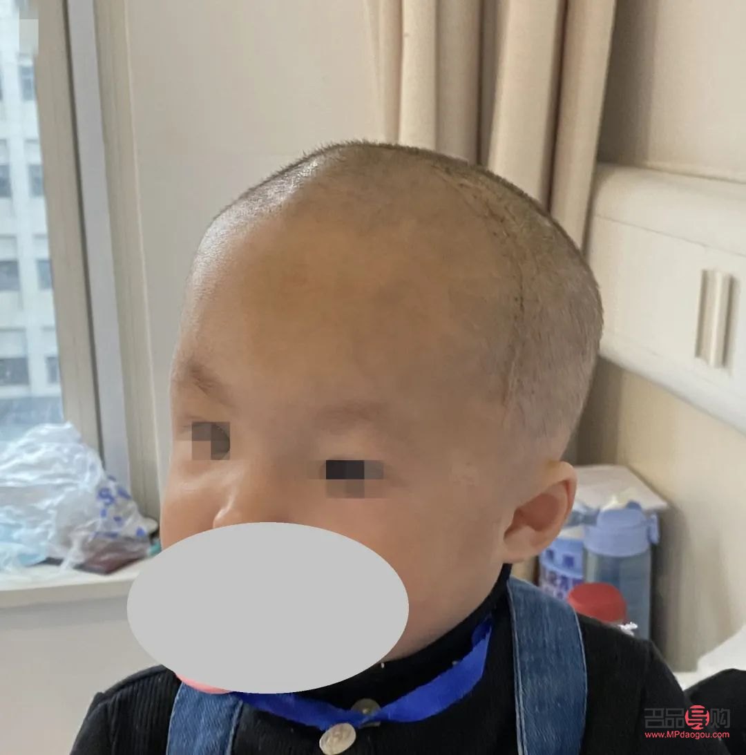 <h3>颅缝早闭与大小眼的关系探究</h3>