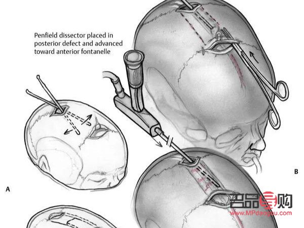 <h3>颅缝早闭与大小眼的关系探究</h3>