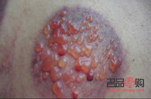 做身体护理有水泡吗(做身体护理有水泡吗怎么办)