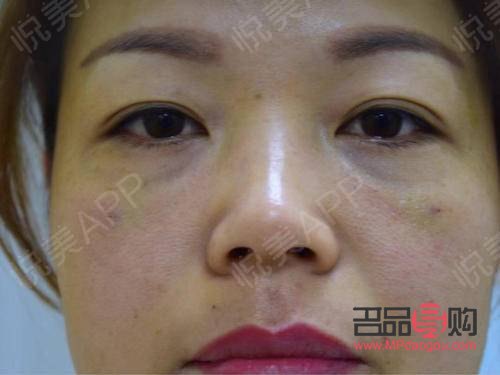 <h3>内切祛眼袋手术效果能持续多久?</h3> <h3>内切祛眼袋手术效果能持续多久?</h3>