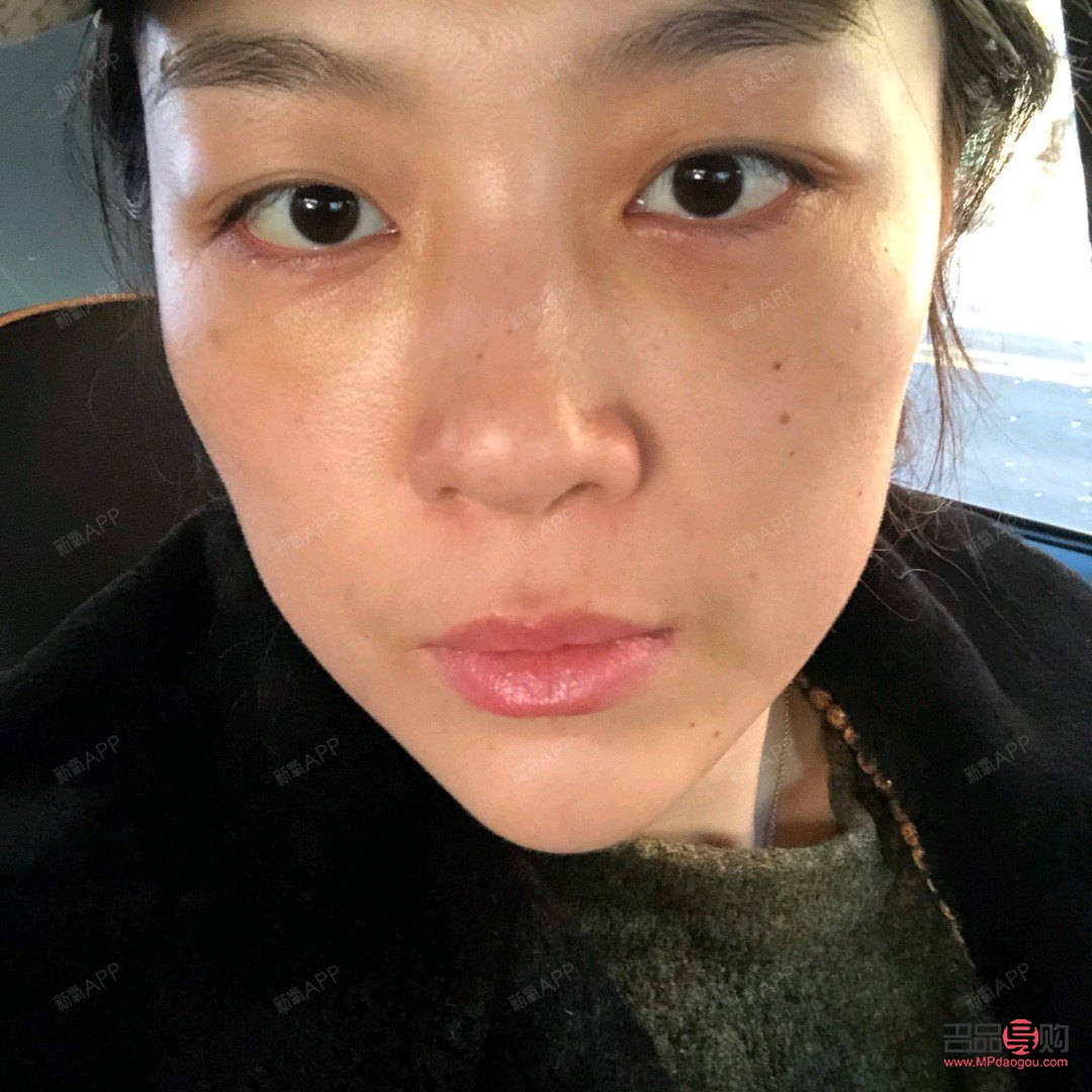 <h3>内切祛眼袋手术效果能持续多久?</h3> <h3>内切祛眼袋手术效果能持续多久?</h3>