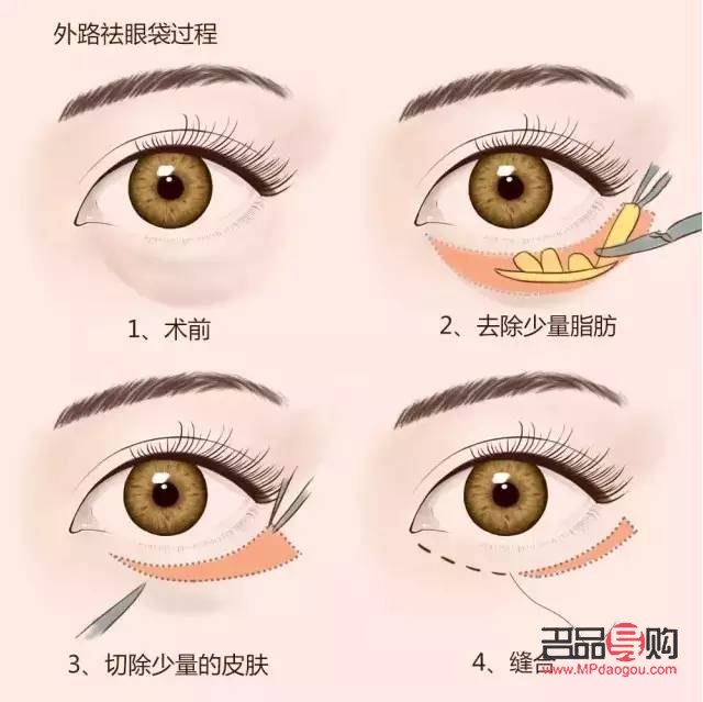 <h3>医美去眼袋手术可能带来的后遗症</h3>