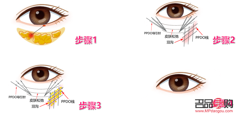 <h3>医美去眼袋手术可能带来的后遗症</h3>