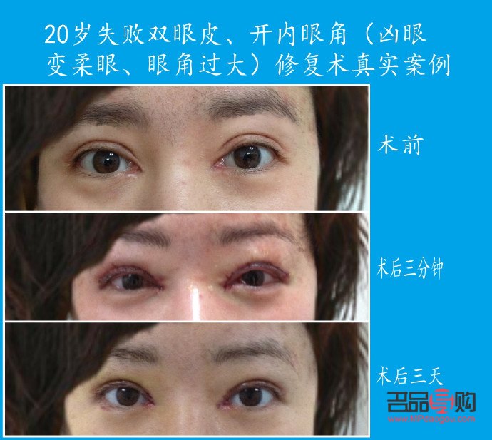 开眼角割双眼皮恢复期详解