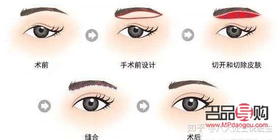 上眼皮松了可以割双眼皮吗(上眼皮松了可以割双眼皮吗视频)