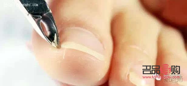 怎么做脚趾美容针(脚趾美容整形)