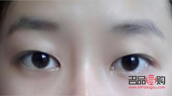 <h3>眼睛内双的女生可以做双眼皮手术吗？</h3>