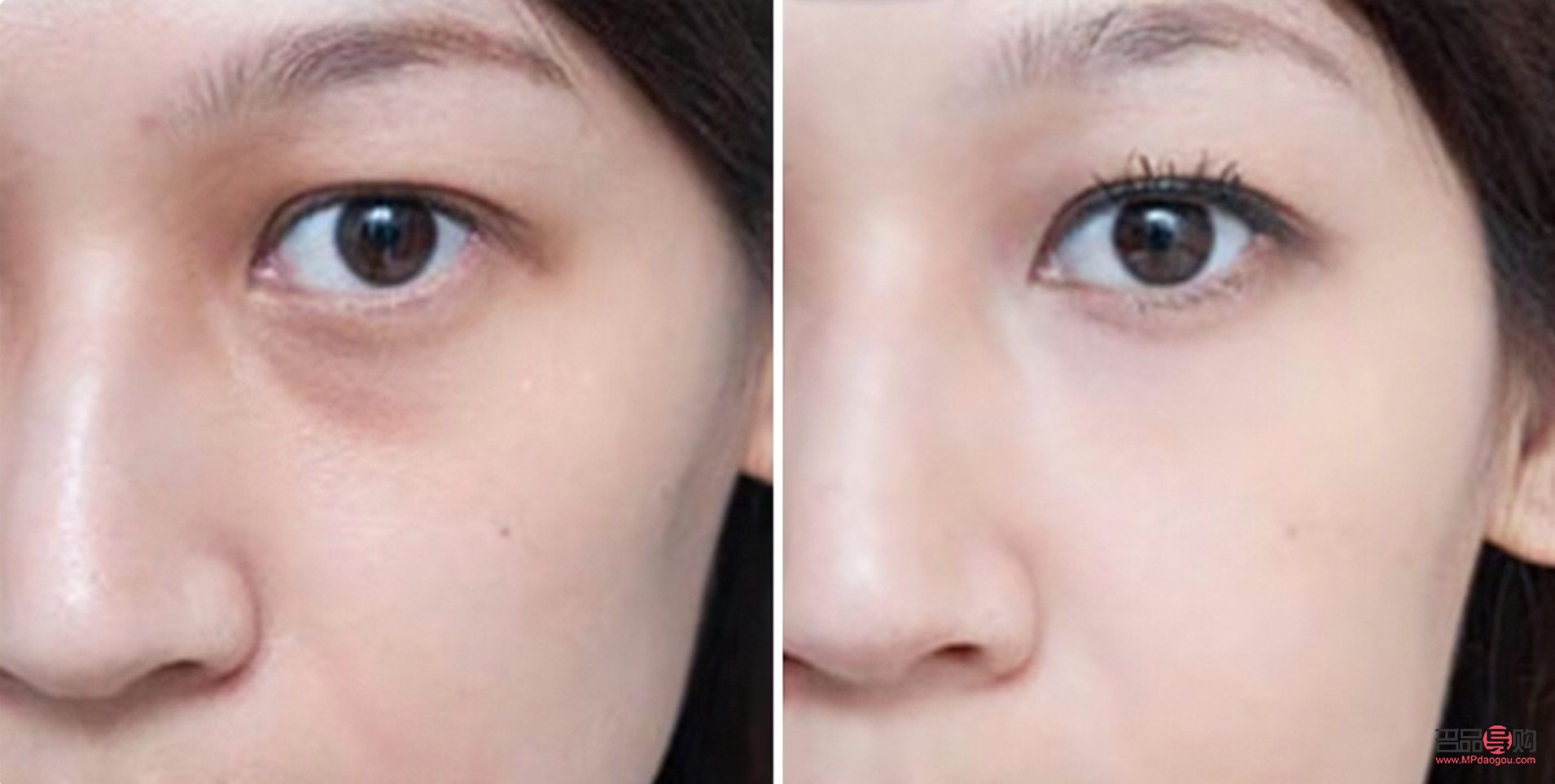 眼窝凹陷能恢复吗(眼窝凹陷能恢复吗图片)