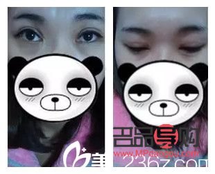 <h3>开眼角双眼皮手术恢复自然所需时间探究</h3>