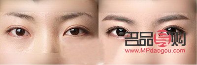 <h3>两个眼皮双的不一样怎么办</h3>