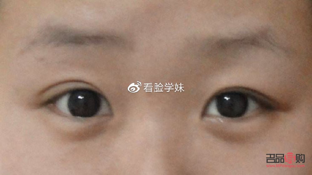 两个眼皮双的不一样怎么办