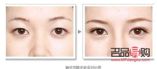 纳米无痕双眼皮属于埋线吗(纳米无痕双眼皮属于埋线吗还是全切)