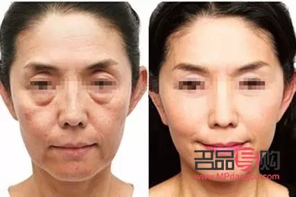 美容脸部提升好吗(美容里面的脸部提升)