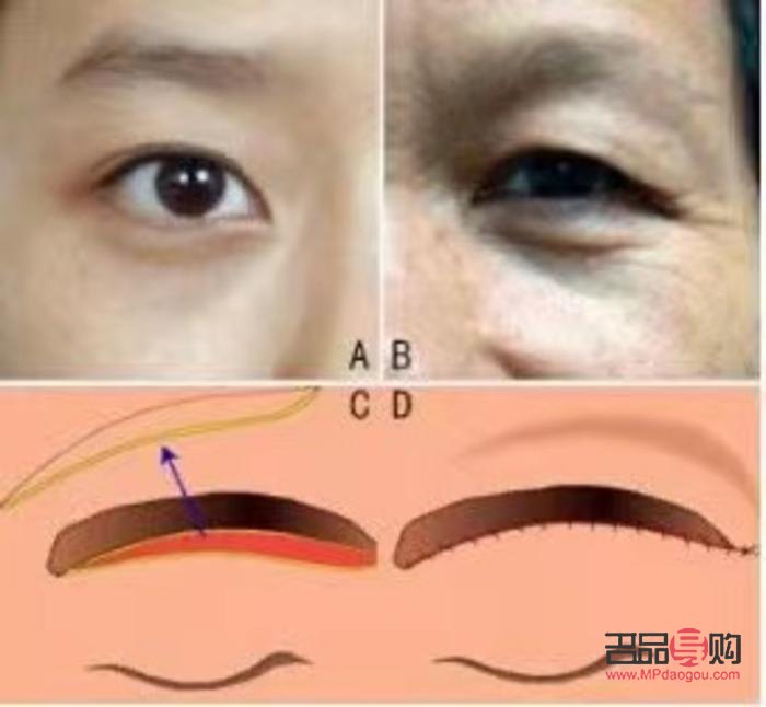 <h3>重塑青春明眸：探索眼皮下垂恢复之道</h3>