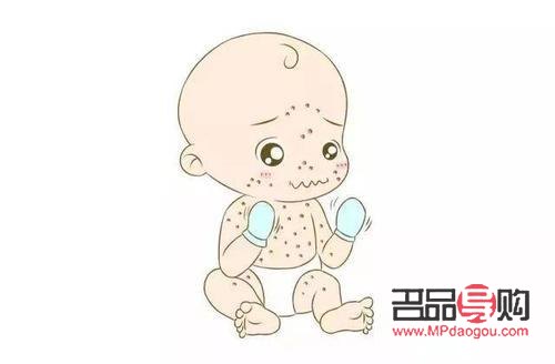 有水痘该怎么护理身体(有水痘该怎么护理身体呢)