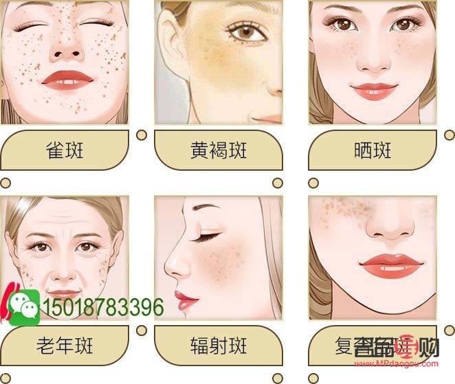 美容能否有效祛斑？