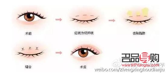 <h3>无痛割双眼皮：真的无痛吗？</h3>