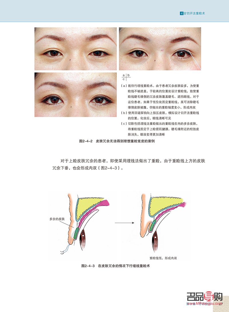 眼整形美容手术(眼整形美容手术图谱)
