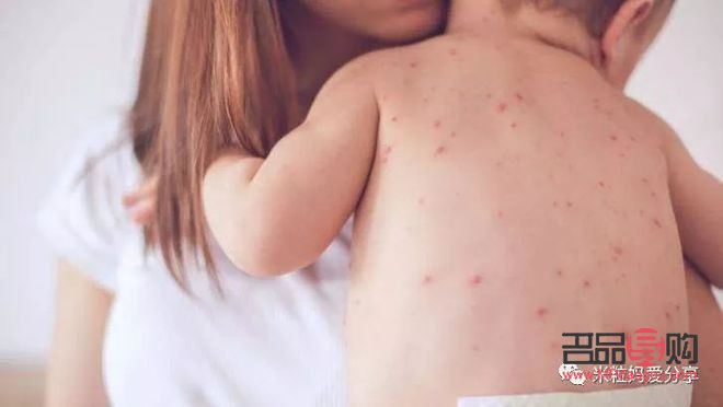 出疹过后怎么护理身体(出疹过后怎么护理身体呢)